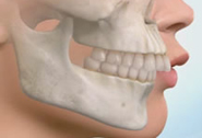 Perfect Smile mal occlusion - excessive 0overjet